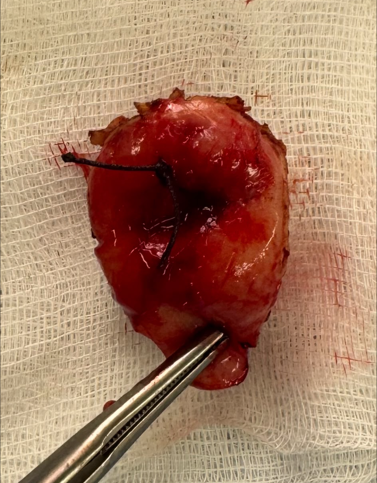 İşlem sonrası specimen materyal örneği