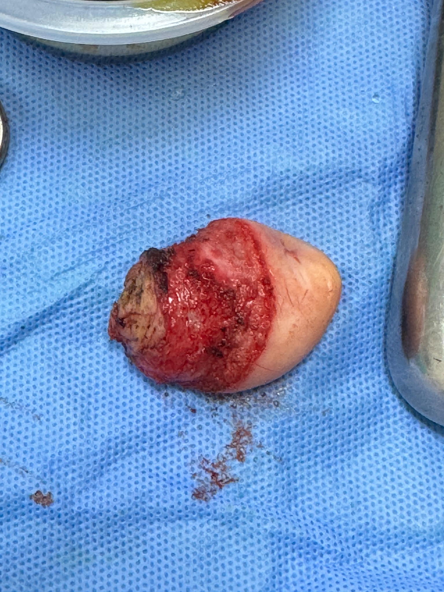İşlem sonrası specimen materyal örneği