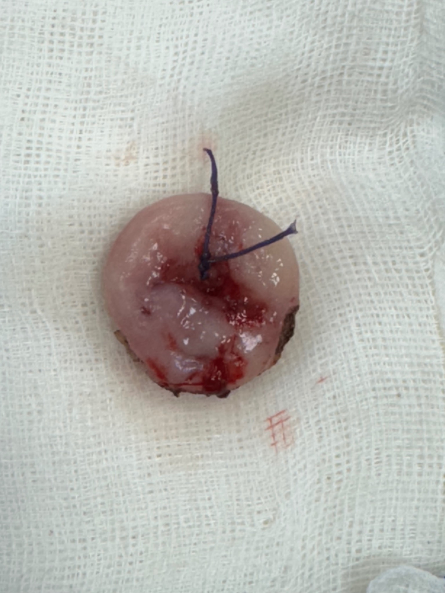 İşlem sonrası specimen materyal örneği