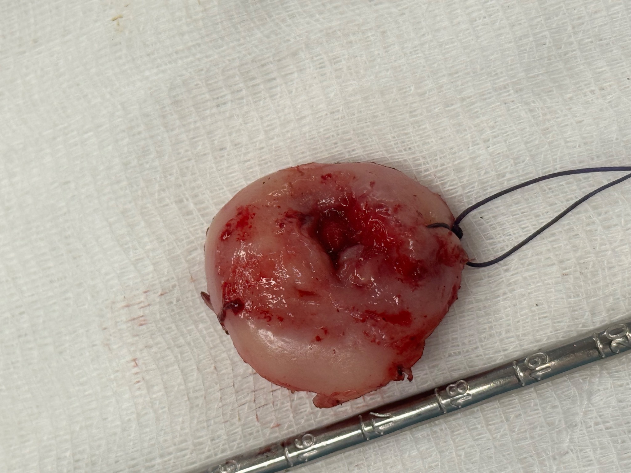 İşlem sonrası specimen materyal örneği