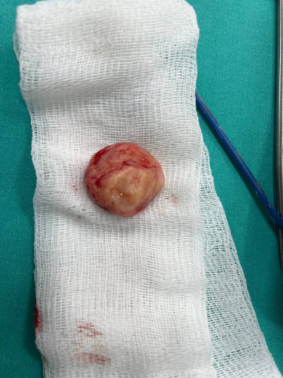 İşlem sonrası specimen materyal örneği