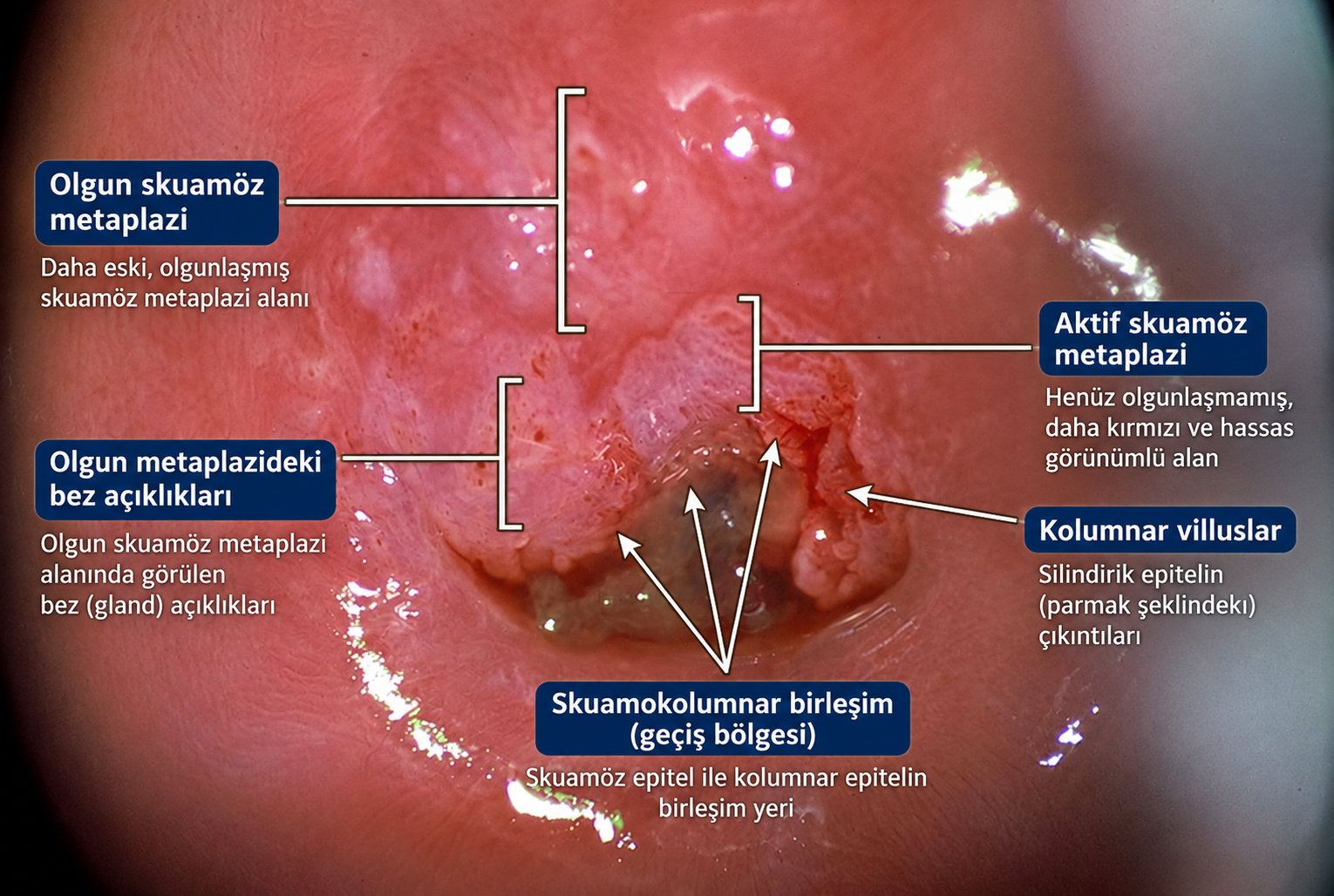 Kolposkopide skuamokolumnar bileşke ve metaplazi