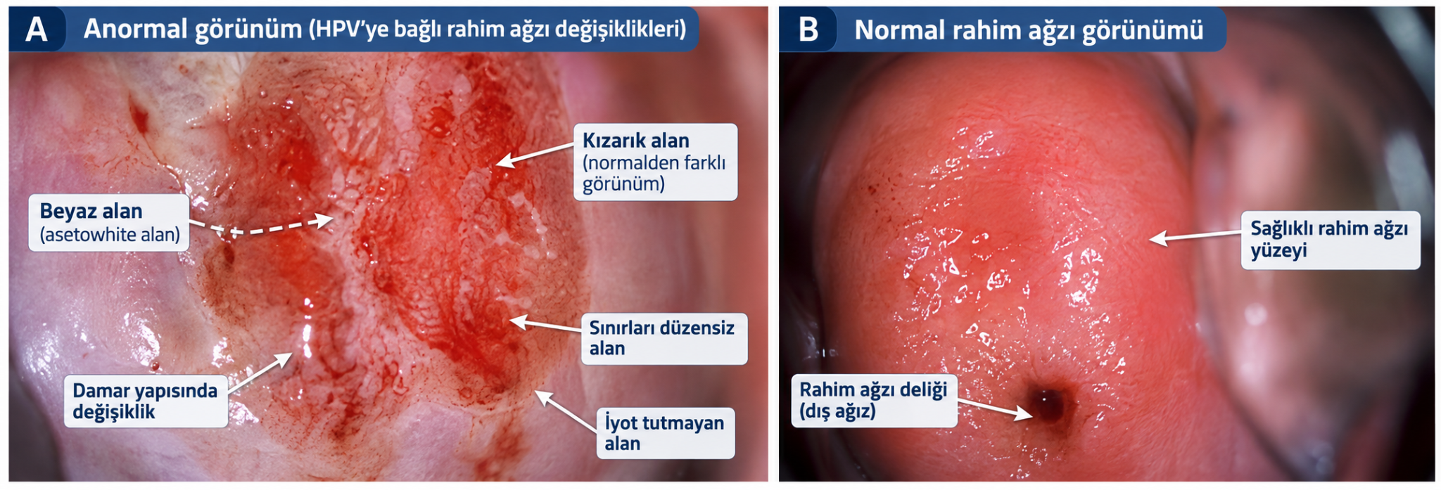Normal ve anormal rahim ağzı kolposkopi görünümü